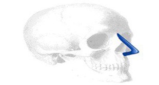 Sizer zu Voloshin Dorsal Columella Nasal Implantat