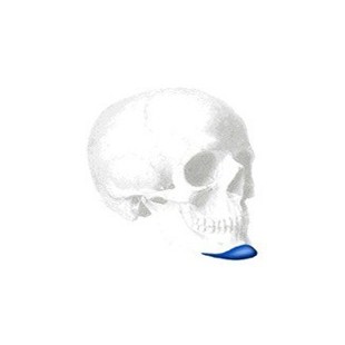 Sizer zu Extended Anatomical Kinn Implantate