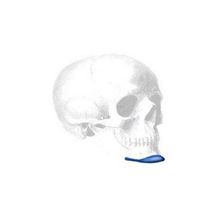 Sizer zu Terino Extended Anatomical Kinn Implantat