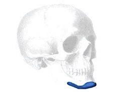 Sizer für Terino Square Kinn Implantate Style II