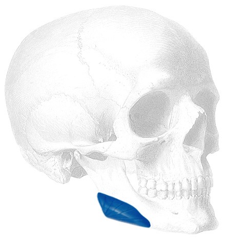 Sizer zu Vertical Mandibular Angle Implantate