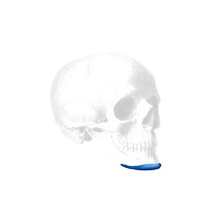 Sizer zu Mandibular Pre Jowl Kinn Implantat