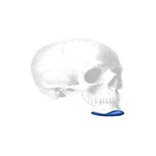 Sizer zu Terino Square Kinn Implantate Style I