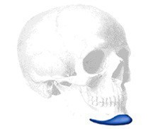 Sizer zu Mandibular Pre Jowl Kinn Implantat