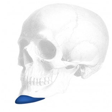 Sizer zu Anatomical Kinn Implantate