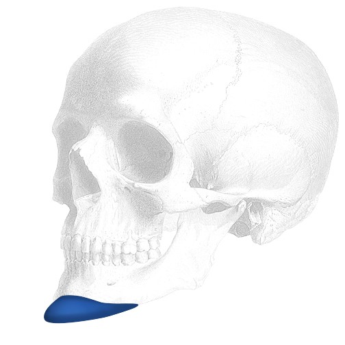 Sizer zu Vertical Lenghtening Kinn Implantate