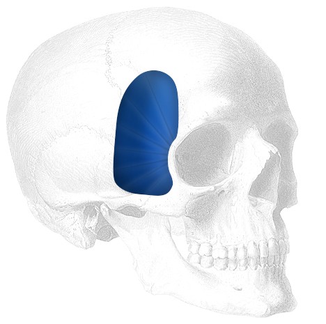 Temporal Shell-Extended Implantat, rechts