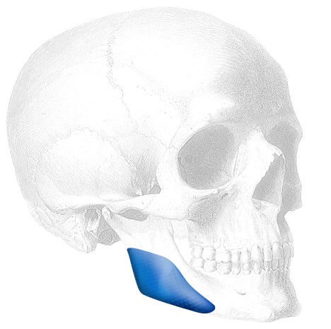 Conform Mandibular Angle Implantat, links